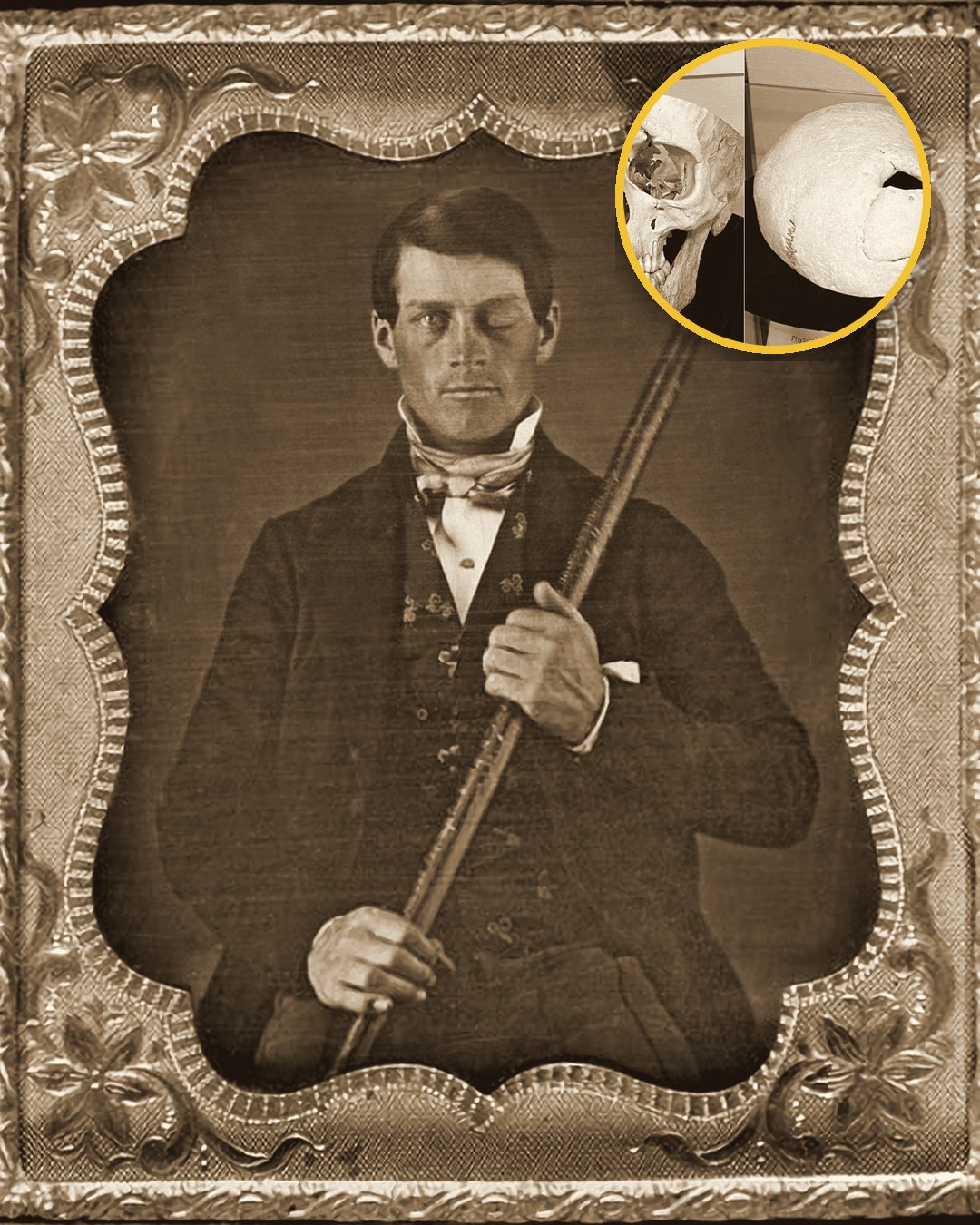 Phineas Gage: thanh sắt xuyên đầu, sống thêm 12 năm